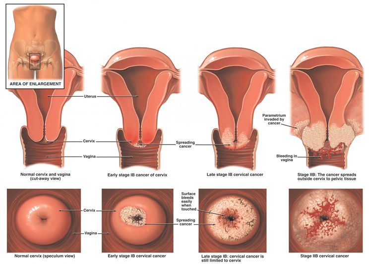 Cervical Cancer Image