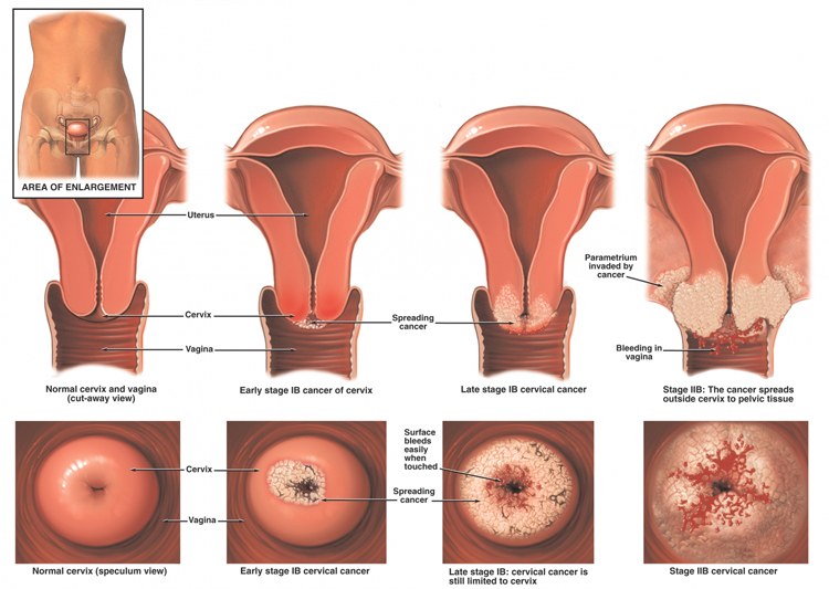 Vaccine For Cervical Cancer